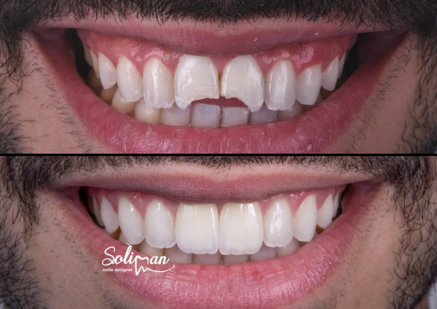 Natural Aesthetics with Zirconia Veneers